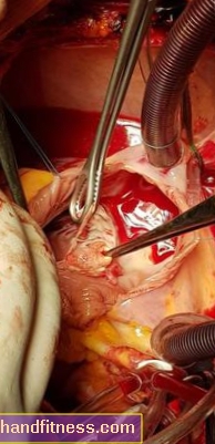 CorMatrix: un método innovador utilizado en el Departamento de Cirugía Cardíaca de la Universidad Médica UCK de Varsovia