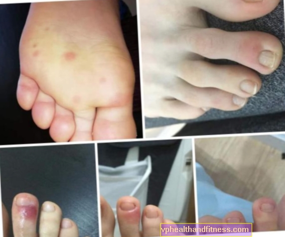 Coronavirus. Klør dine fødder? Det kan være et tegn på en infektion!