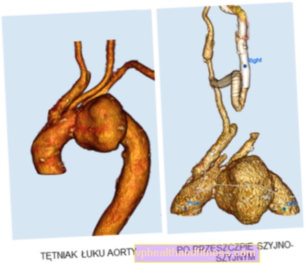 Innovativ kirurgi av aortabågens aneurysm vid University Clinical Center vid det medicinska universitetet i Warszawa