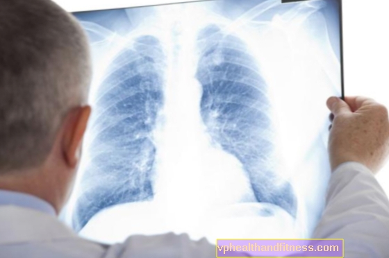 Patienter med lungcancer har begränsad tillgång till modern behandling