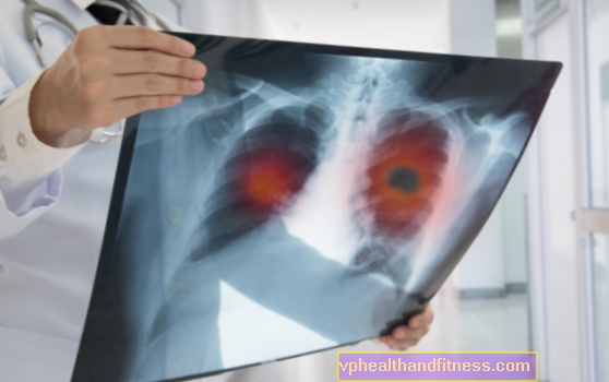 Pienācis laiks integrētām aktivitātēm plaušu vēža slimnieka aprūpē