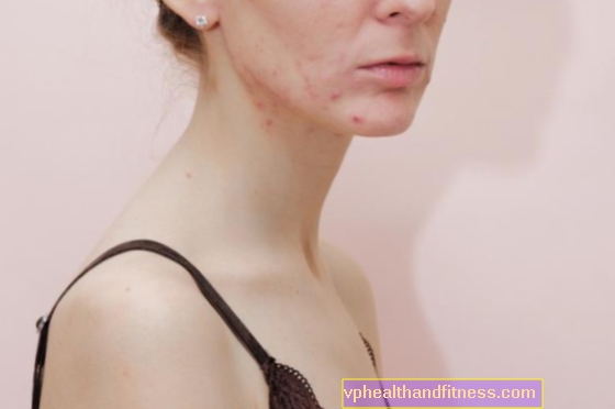 Алергія на маску. Домашні засоби від сухої та роздратованої шкіри