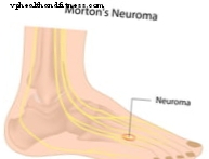 Hvad er Mortons neuroma