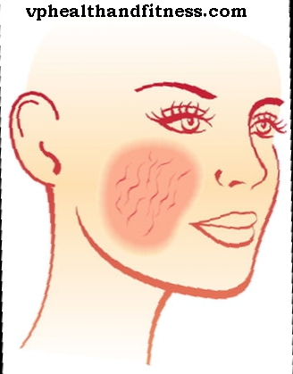 Acne rosacea - symtom och behandling