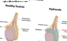 Simptomi i liječenje hidrocele