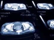 Plaučių vėžys gali tapti pagrindine moterų vėžio mirties priežastimi 2015 m
