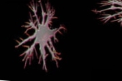 Lovende hjernecelletransplantasjon for å reversere hukommelsestap hos Alzheimers