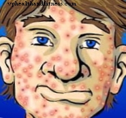 A acne não é mais apenas um problema adolescente