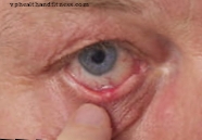 Begrensning av bruk av kontaktlinser om kvelden demper effekten av allergier