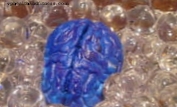 एक नई तकनीक से एडीएचडी के रोगियों में मस्तिष्क के लोहे के निम्न स्तर का पता चलता है