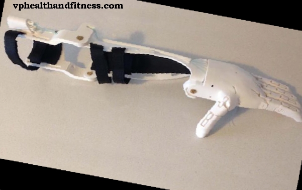 Cenejše proteze s 3D-tiskalniki