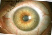 Офталмология: те включват лазерна система за опериране на катаракта с по-голяма точност