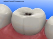 Çürük beş yıl içinde sakız, yoğurt veya diş macunu ile önlenebilir