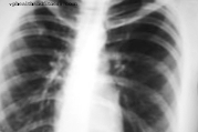 Pulmonoloogid hoiatavad kahe uue viiruse eest, mis põhjustavad hingamisteede nakkusi