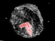 Skanneri rintasyövän näkemiseen kolmiulotteisesti