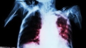 Greitas tyrimas tuberkuliozei nustatyti