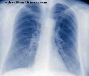 폐 폐기종 환자의 흉부 수술 대안을 개발합니다.