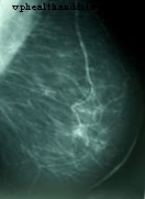 'Tečna biopsija' za špijuniranje raka dojke