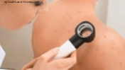 Успешна ваксина срещу рак на кожата