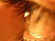 Aklumo rizika dėl glaukomos per 30 metų sumažėjo perpus