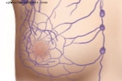 Spānijas onkologi sagatavo rokasgrāmatu par agresīvu krūts vēzi