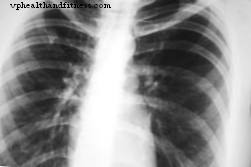 Tuberkuliozė: simptomai ir gydymas
