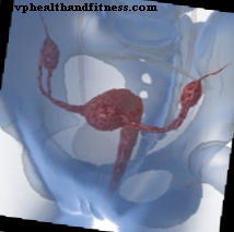 Endometritas ar dubens organų uždegiminė liga