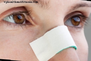 Zlomenina nosu: příčiny, příznaky a léčba