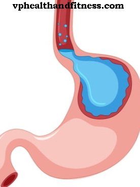 Gastroezofageální reflux: žaludeční reflux