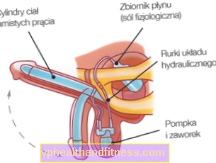 Prótese peniana hidráulica - prótese peniana cirúrgica para problemas de ereção