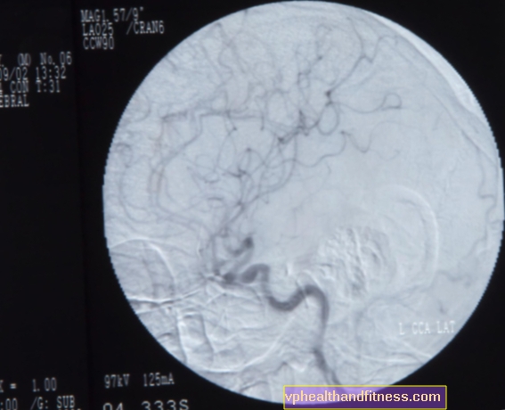 Arteriografie: röntgenonderzoek van de slagaders