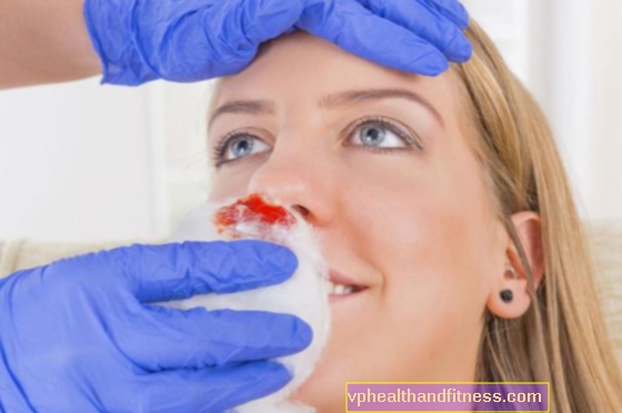 नाक से रक्तस्राव: कारण