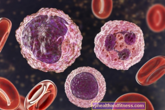 Linfocitosis: ¿evidenciada por niveles demasiado altos de linfocitos?