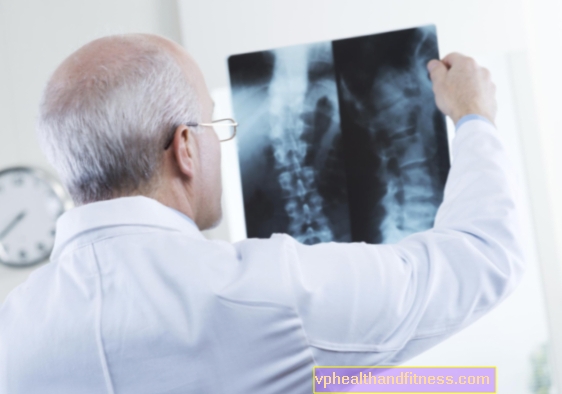 Osteoporosis: ¿qué pruebas ayudarán a identificar la descalcificación ósea?