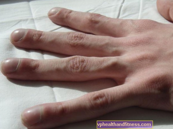 Roterende fingre - årsager. Hvilke sygdomme angiver fingre?