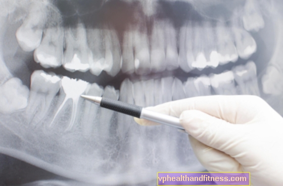 Radiographie (radiographie) des dents - examen radiologique des dents