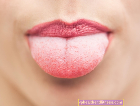 Cambiar el color de la lengua es un síntoma de la enfermedad.