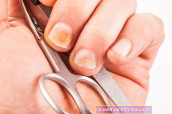 5 huskurer för gula naglar