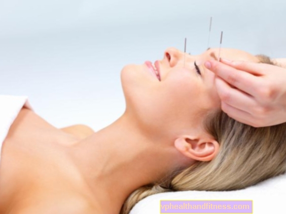 Acupuntura cosmética: una forma de rejuvenecer. ¿Es eficaz la acupuntura?