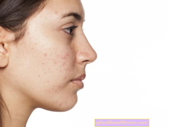 Piel con acné: características y cuidados. ¿Cómo reconocer la piel con acné?