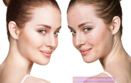 Cosméticos para el acné. ¿Qué usar para pieles con acné y seborrea?