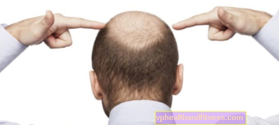 Alopecia androgenética en hombres. Medicamentos para la caída del cabello en hombres.