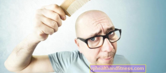 Calvicie en los hombres: causas y tratamiento de la caída del cabello