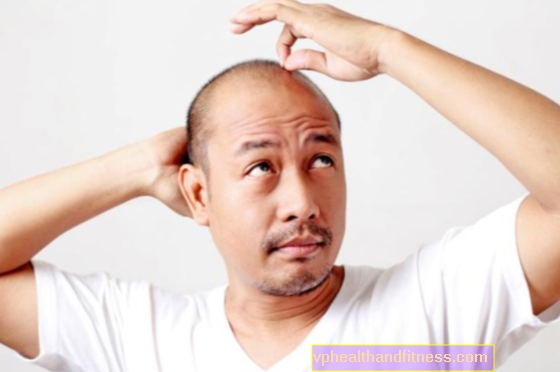 Kahlheit. Alles, was Sie über die Art und Behandlung von Haarausfall wissen müssen