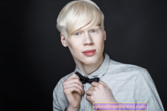 Albinizmas (įgimtas albinizmas) - tipai, priežastys, simptomai. Ar galima išgydyti albinizmą?
