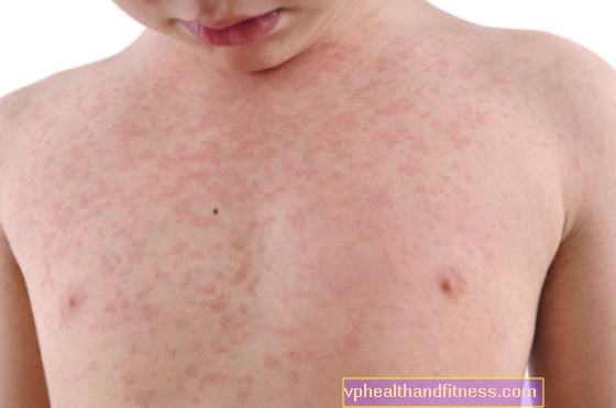 Контактна алергия при деца: причини, симптоми, лечение