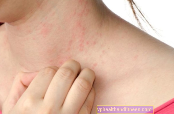 Hudallergi: hur man bekämpar allergi