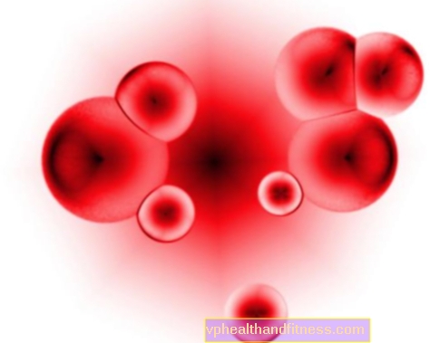 Сърповидно-клетъчна анемия - причини, наследяване, симптоми и лечение