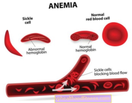 Anémie: nedostatek železa. Příznaky a příčiny anémie