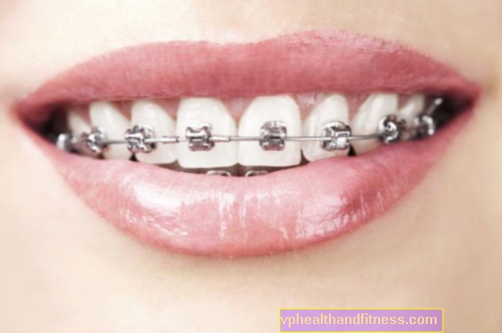 Aparatos de ortodoncia: tipos, colocación e higiene
